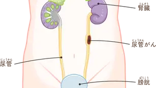 尿管がんを示すイラスト