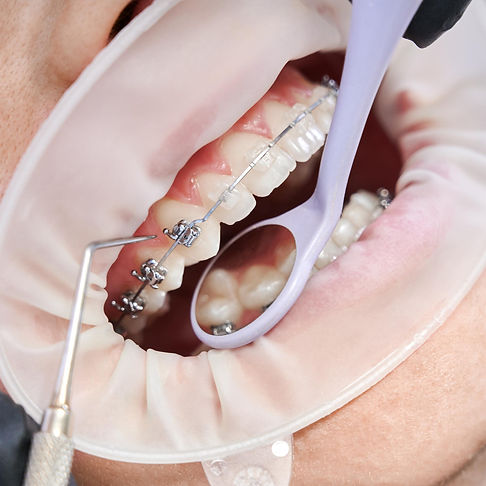dentista-anexando-aparelhos-metalicos-aos-dentes-do-paciente.jpg