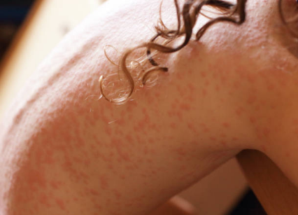 Full body Eczema flare on woman’s back with visible redness, dry patches, and rough, irritated skin texture. Photo by Lizalica