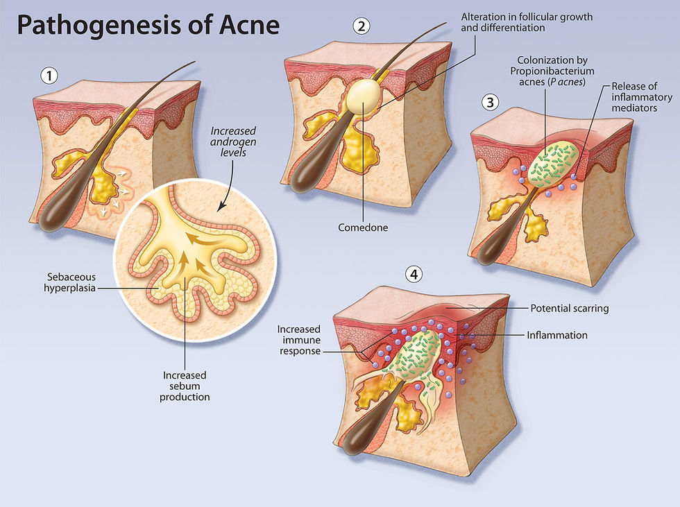 Acne pathogenesis diagram showing how excess sebum, abnormal skin cell shedding, follicular plugging, Cutibacterium acnes, and inflammation contribute to acne formation.
