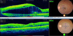 RETINAL EDEMA BEFORE AND AFTER TREATMENT
