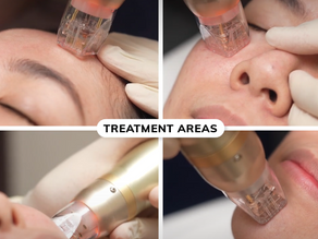 Top 10 places to get microneedling treatments in SG