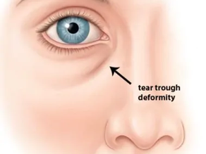 Top 5 Clinics for Undereye Fillers in Singapore (2026 Guide)