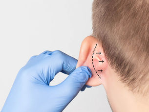 Auriculoplastía
