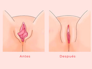 Cirugía Genital Femenina