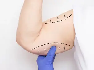 Dermolipectomía y Lifting de brazos