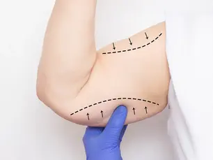 Dermolipectomía y Lifting de brazos