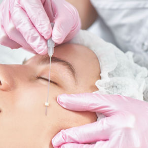 What Are PDO Threads? The Non-Surgical Lift Palm City Patients Are Raving About