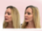Actual patient. Results shown after French Lift®.