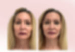 Actual patient. Results shown after French Lift®.