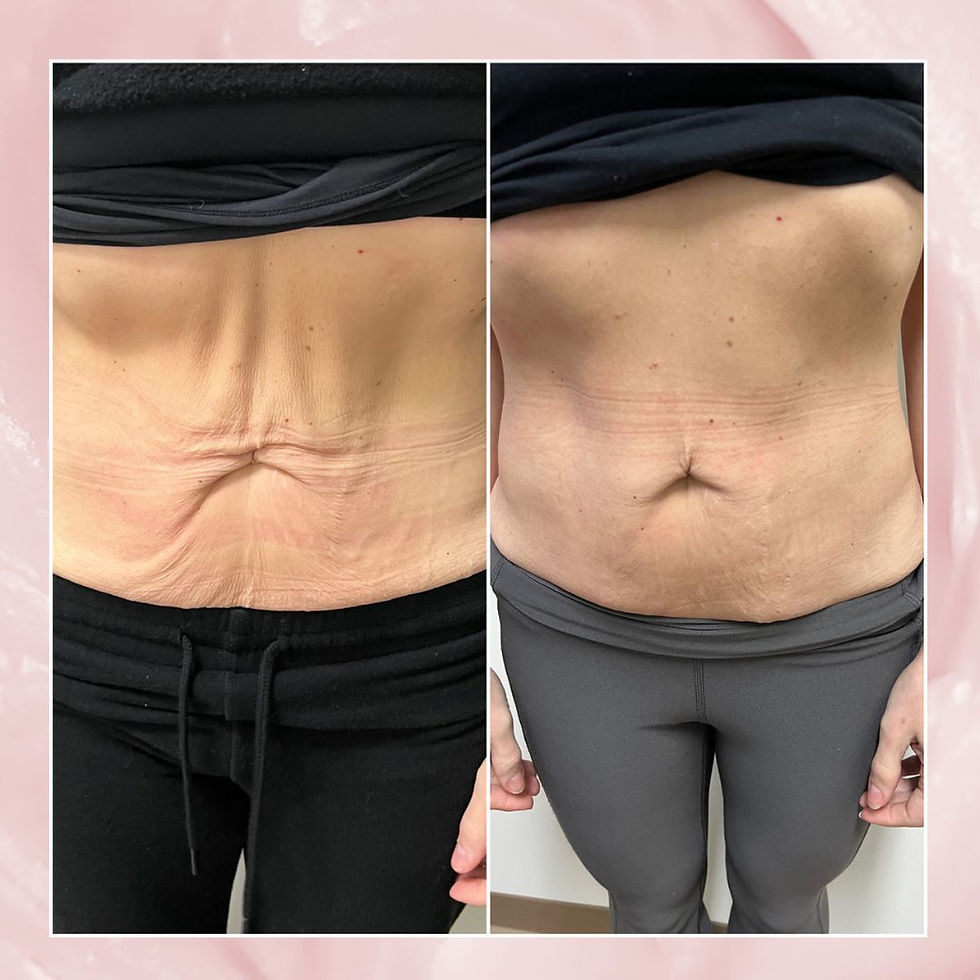 Belly fat removal without surgery, using Evolve X