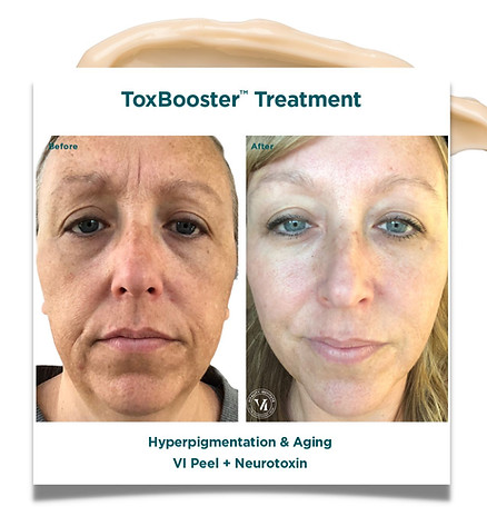 Glo-Aesthetics-VI-Peel-Tox-Booser-Before-After-2.jpg