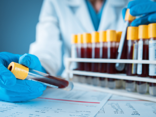 Scientists close in on blood test to stop spread of tuberculosis