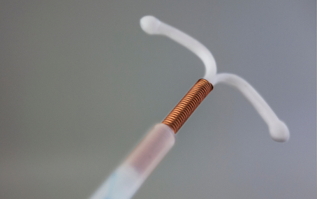 IUCD: Sekali Pasang, 5 Tahun Tenang