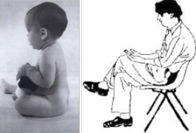 Forward head posture