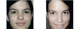 6-green-peel-befor-after-photos-2.png