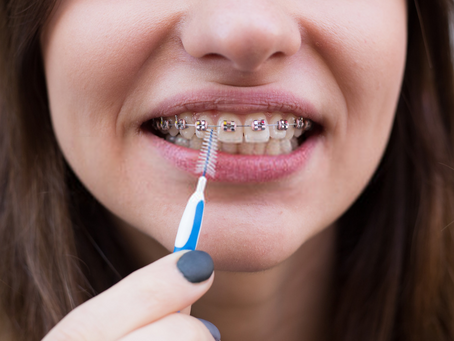Como fazer a higiene bucal com aparelho ortodôntico