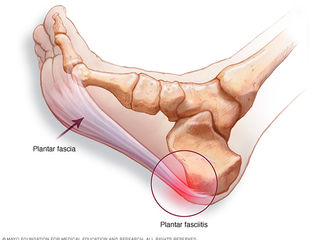 Plantar Fasciopathy: What do we know?