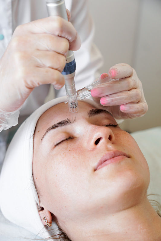 microneedling.jpeg
