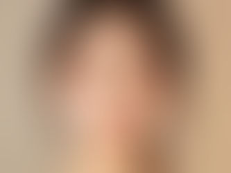 韓国の皮膚科はニキビ(活動性ニキビ)をどう治療するか 完全ガイド