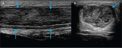 Ultrasound image showing tendon thickening and structural irregularity in Achilles tendinopathy.