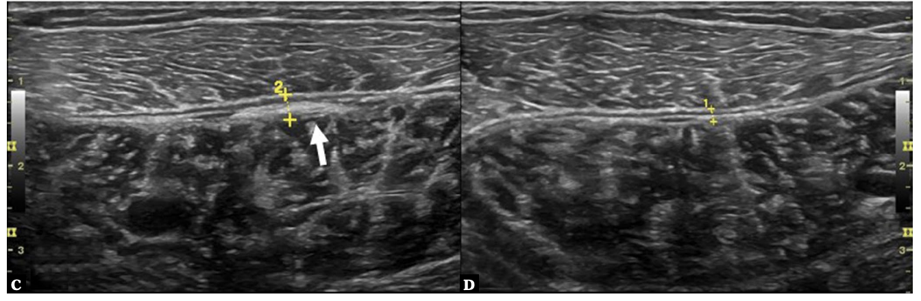 Long-axis ultrasound images of the medial gastrocnemius comparing a previously injured limb with the contralateral asymptomatic side, demonstrating subtle hyperechoic thickening of the aponeurosis consistent with residual scar remodeling after a muscle strain.