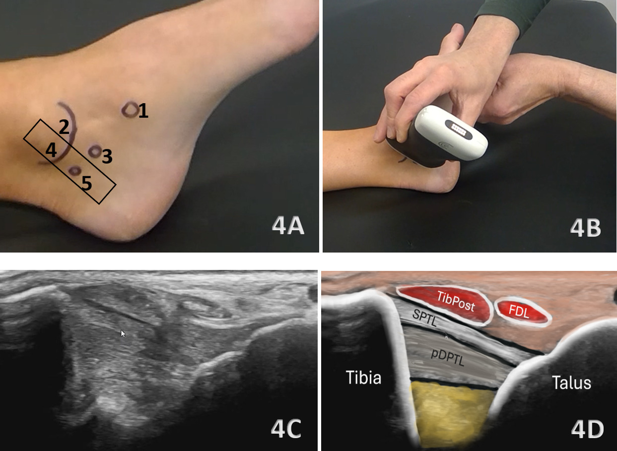 Four-panel image demonstrating ultrasound evaluation of the deltoid ligament. Panel 4A shows anatomical landmarks and probe orientation on the medial ankle. Panel 4B displays a clinician performing a medial ankle ultrasound scan using a handheld device. Panel 4C shows the corresponding grayscale ultrasound image of the deep deltoid ligament structures. Panel 4D provides a labeled anatomical overlay highlighting the tibialis posterior (TibPost), flexor digitorum longus (FDL), superficial posterior tibiotalar ligament (SPTL), and deep posterior tibiotalar ligament (pDPTL) between the tibia and talus.
