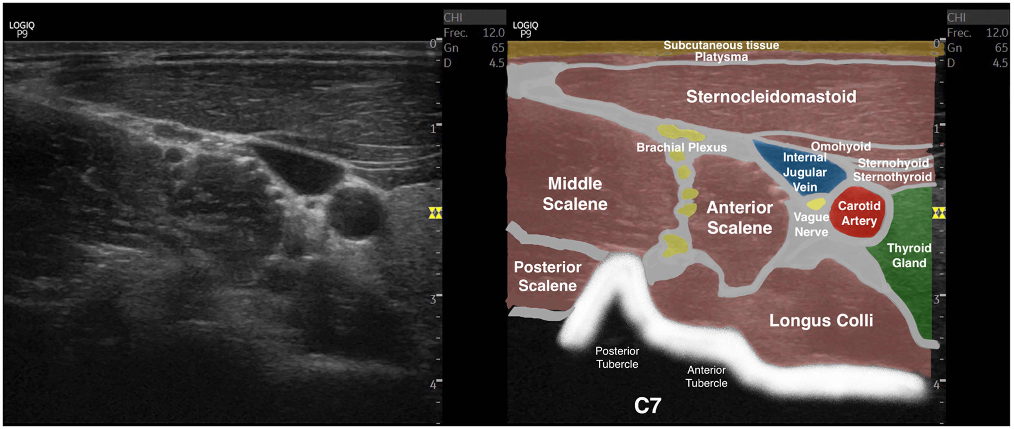 Ultrasound image and labeled anatomical diagram showing anterior scalene muscle, brachial plexus, carotid artery, and surrounding cervical structures.
