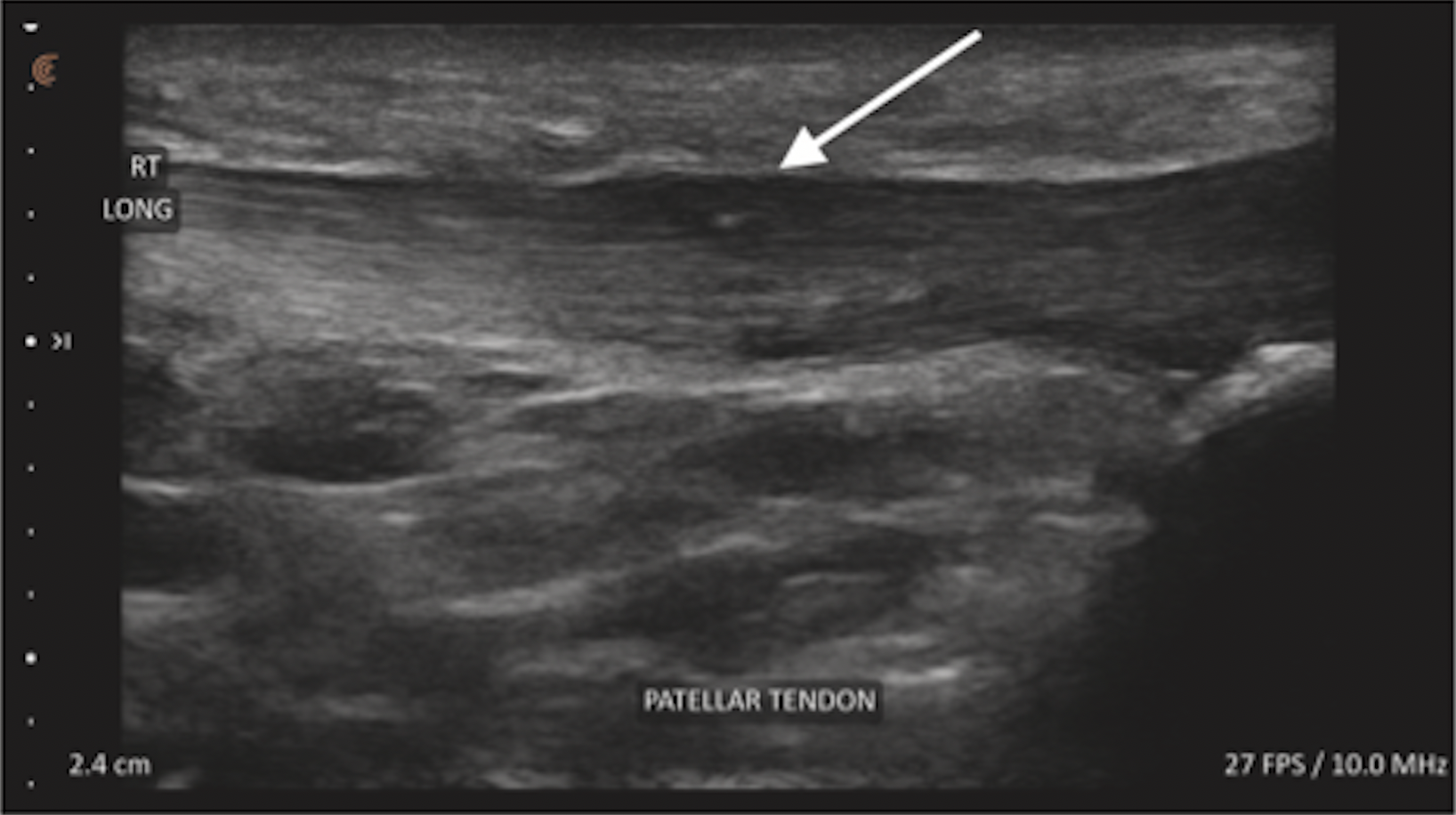 Longitudinal patellar tendon ultrasound showing thickening and disorganized fibrillar architecture, with an arrow marking the abnormal region.