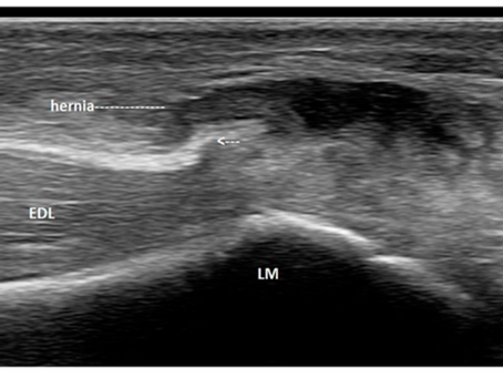 Long-axis ultrasound of the right ankle showing a focal fascial defect in the extensor digitorum longus (EDL) over the lateral malleolus with superficial muscle herniation visible at rest.