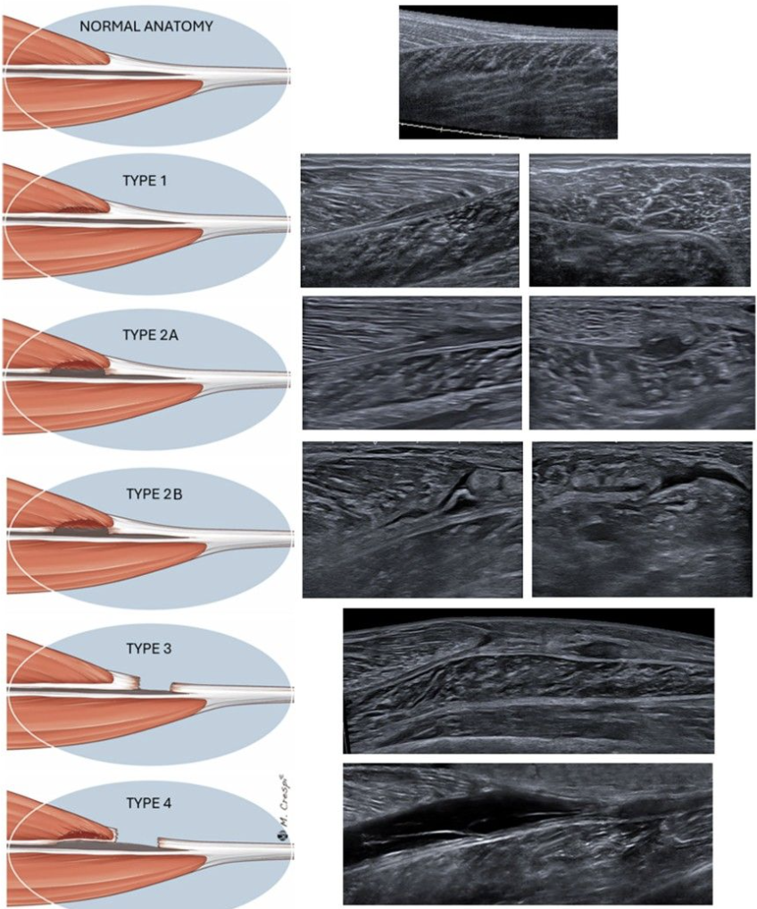 Diagram showing gastrocnemius and soleus injury locations at the myotendinous junctions, aponeuroses, and central soleus tendon.