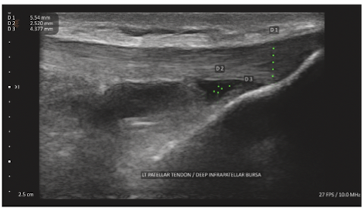 Longitudinal ultrasound showing fluid in the deep infrapatellar bursa beneath the distal patellar tendon.
