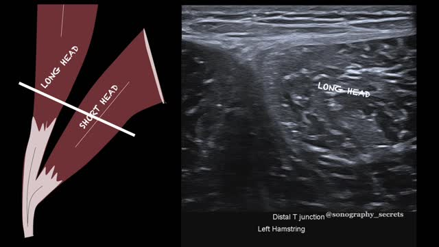 Illustration and corresponding transverse ultrasound image demonstrating the convergence of the long head and short head of the biceps femoris at the distal T-junction. This composite connective-tissue interface plays a key role in force transfer and intermuscular coordination and is a common site of clinically significant hamstring injury.