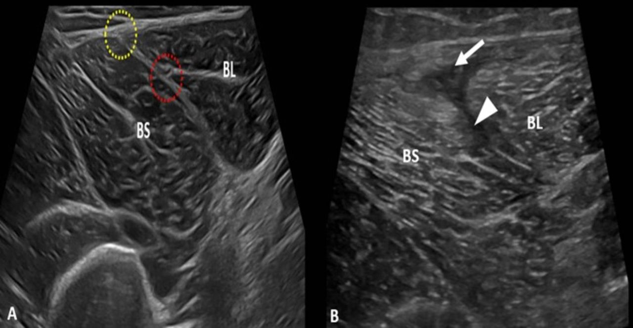 Transverse ultrasound images of the distal biceps femoris demonstrating the relationship between the long head (BL) and short head (BS) at the T-junction. The interface between the two muscle heads is highlighted, with focal disruption and altered echotexture suggesting loss of normal connective-tissue continuity. Arrows indicate the region of interest where shear and abnormal tissue behavior may be appreciated under dynamic loading.