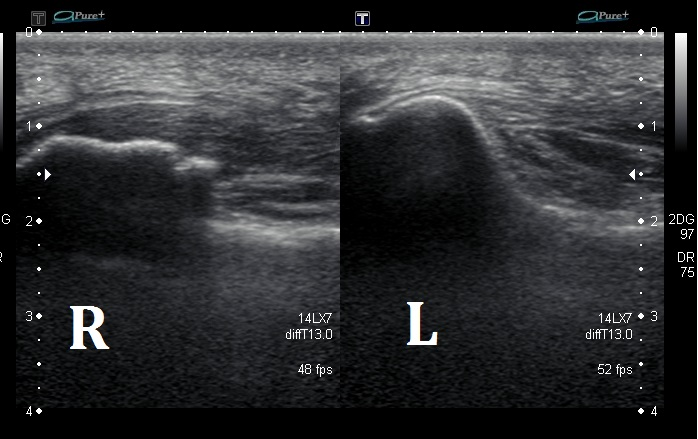 Ultrasound comparison of right and left plantar fascia showing swelling and irregular structure consistent with plantar fasciitis.