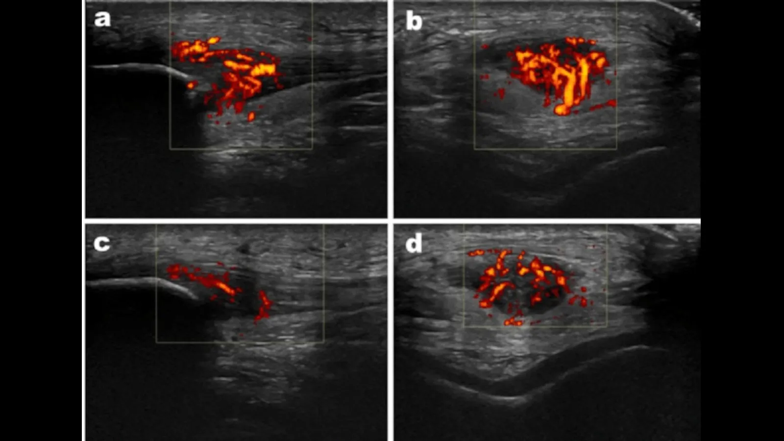 Power Doppler musculoskeletal ultrasound images showing increased intramuscular vascular signal consistent with hyperemia, illustrating inflammatory or reparative activity within muscle tissue