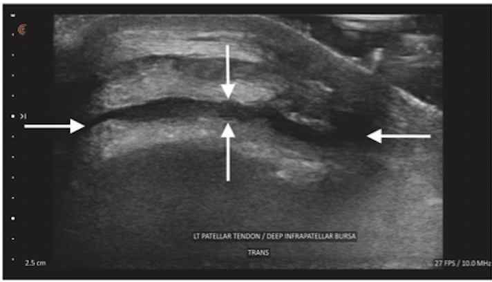 Transverse ultrasound showing deep infrapatellar bursal fluid posterior to the patellar tendon, indicated by arrows.