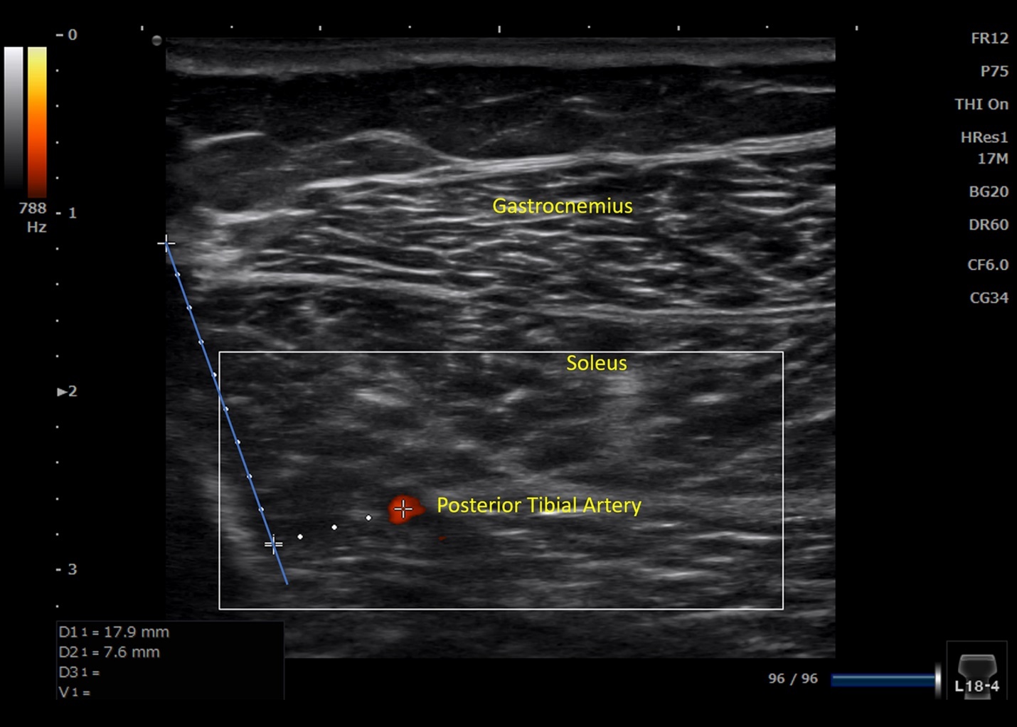 Ultrasound image showing gastrocnemius and soleus muscles with the posterior tibial artery identified as a safety structure during needle procedures.

