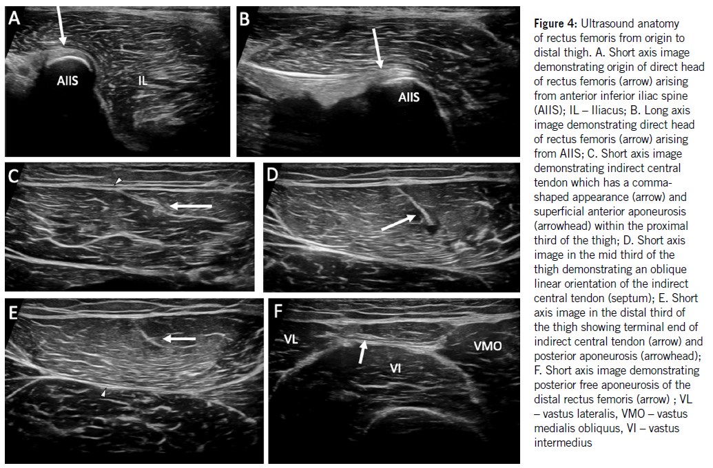 Ultrasound images of rectus femoris from origin to distal thigh: A–B show direct head from AIIS, C–E show central tendon and aponeurosis in short and long axis, F shows posterior aponeurosis of distal rectus femoris with adjacent vastus lateralis, vastus medialis obliquus, and vastus intermedius.
