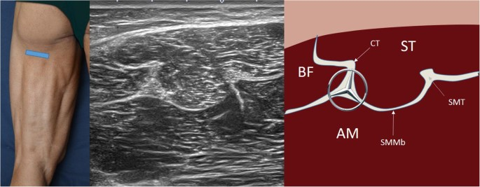 Composite image showing medial hamstring probe placement on the thigh, corresponding ultrasound image of muscle and connective tissue, and anatomical diagram labeling semitendinosus, semimembranosus, biceps femoris, and connective tissue structures.