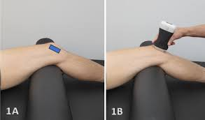 Power Doppler musculoskeletal ultrasound images showing increased intramuscular vascular signal consistent with hyperemia, illustrating inflammatory or reparative activity within muscle tissue.