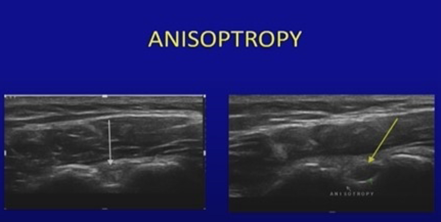 Side-by-side longitudinal ultrasound images of the long head of the biceps tendon demonstrating normal echogenic appearance with proper beam alignment compared to hypoechoic artifact caused by anisotropy from probe angulation.