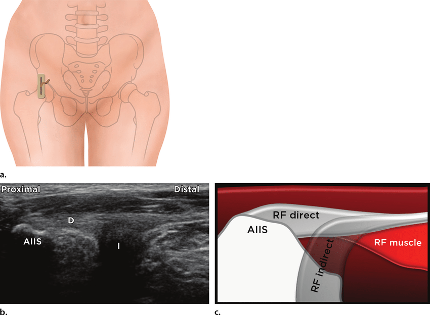 Ultrasound anatomy of proximal rectus femoris with probe placement over AIIS, highlighting direct and indirect head attachment to pelvis.