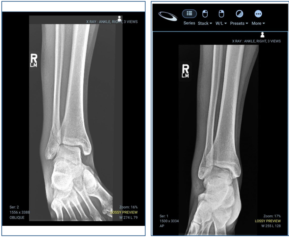 Anteroposterior and oblique radiographs of the right ankle demonstrating a nondisplaced distal fibular fracture at the lateral malleolus. The fracture line is visible above the ankle joint with preserved alignment and no obvious syndesmotic widening.