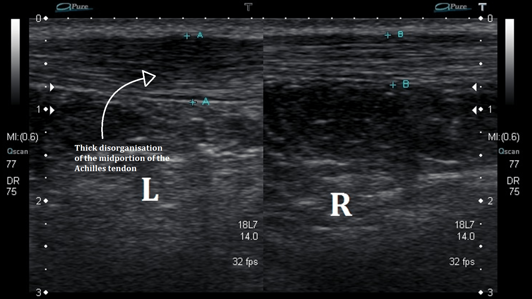 Side-by-side ultrasound scan comparing left and right Achilles tendons, highlighting thickened degenerative changes on the affected side.