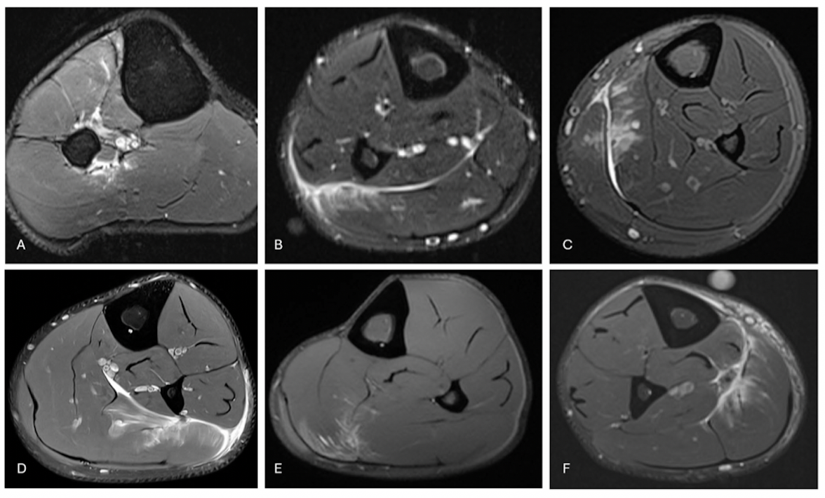 Six MRI images showing soleus injuries involving the proximal tendinous arch, anterior, posterior, lateral and medial aponeuroses, and central tendon.