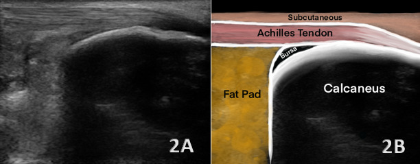 Achilles Tendon Ultrasound Anatomy and Landmark Identification