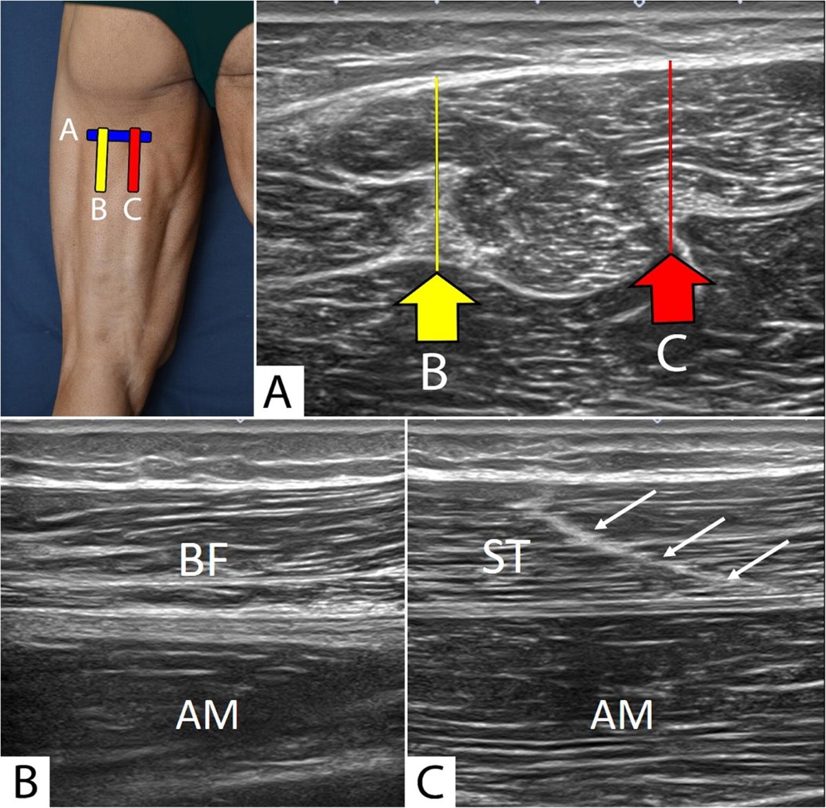 Long-axis musculoskeletal ultrasound images of the posterior thigh demonstrating hamstring anatomy, including the biceps femoris and semitendinosus overlying the adductor magnus, with annotated probe positions corresponding to anatomical landmarks used during dynamic assessment.