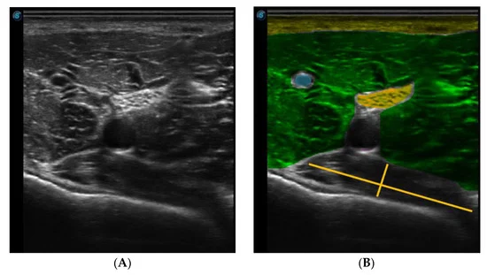 Comparison ultrasound images demonstrating identification of nerves and vascular structures to improve safety during musculoskeletal interventions.
