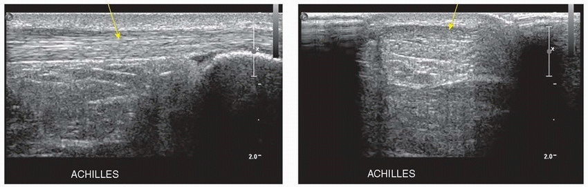 Side-by-side ultrasound images of the patellar tendon showing longitudinal (long-axis) and transverse (short-axis) planes to illustrate fiber orientation and cross-sectional morphology.